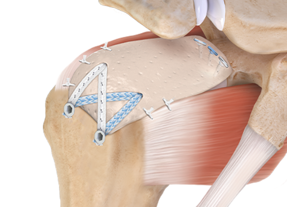 Arthrex - PowerPick, 45° 6 mm Drill Depth - AR-8150PX-45